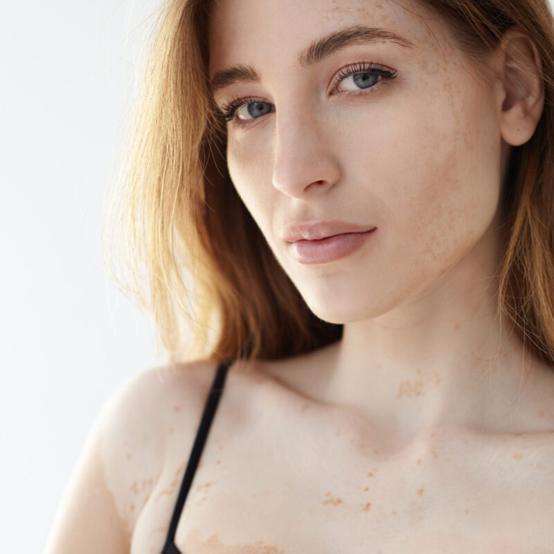 Vertical shot of beautiful gorgeous female model with loose hair and sensual lips having vitiligo affected skin with white patches on her chest, dressed in black tank top, looking at camera